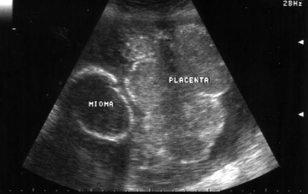 Miomas durante el embarazo