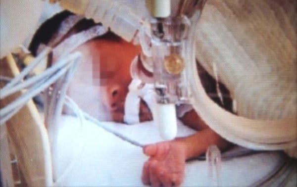 Un bebé prematuro declarado muerto revive antes de ser cremado