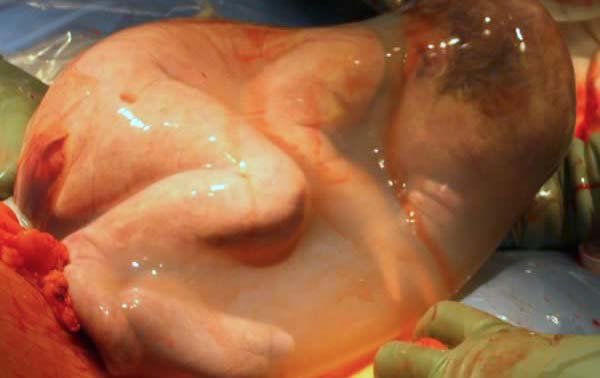 El bebé que nació dentro del saco amniótico