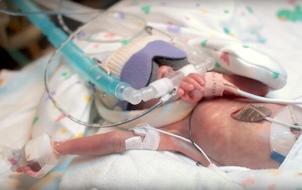 Conmovedor video de la evolución de un bebé prematuro de 25 semanas