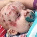Una mamá comparte la imagen de su bebé con varicela para concientizar sobre la vacunación