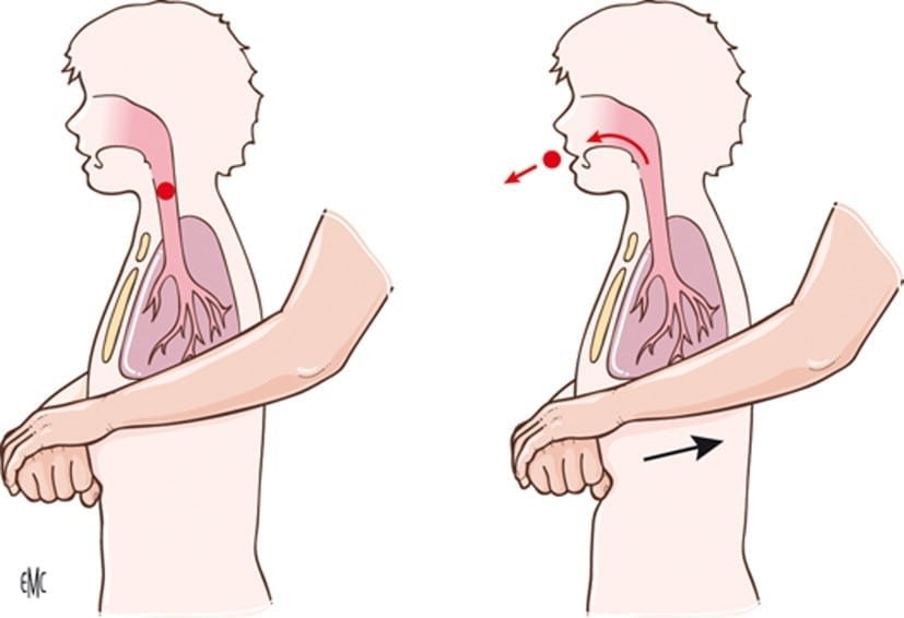 Maniobra de Heimlich o compresión abdominal