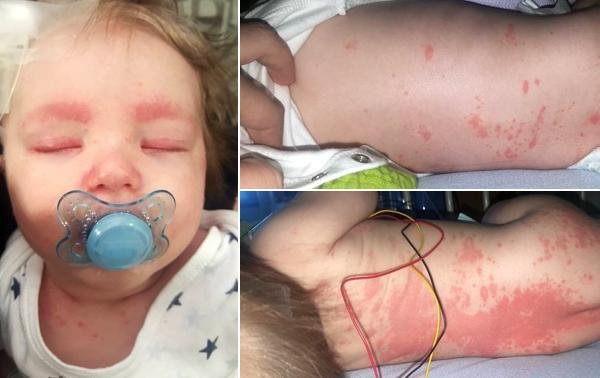 Una mamá comparte la foto de su bebe con meningitis