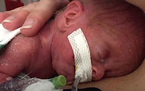 La bebé ‘milagro’ que nació prematura a las 25 semanas se recuperó totalmente
