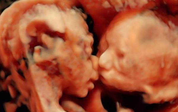 Una ecografía de dos gemelas besándose en el vientre materno cautiva Internet