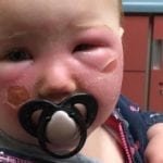 ALERTA: Una bebé sufre quemaduras luego de que le aplicaran un bloqueador solar