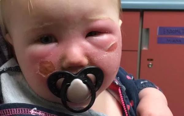 ALERTA: Una bebé sufre quemaduras luego de que le aplicaran un bloqueador solar