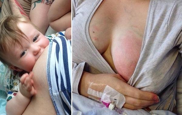 "Esto es mastitis": Una madre comparte la foto de la infección para ayudar a prevenirla