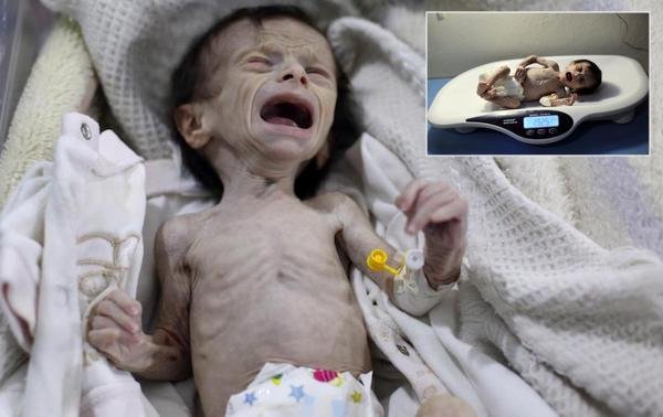 Las dramáticas imágenes de una bebé desnutrida muestran el horror de la guerra en Siria
