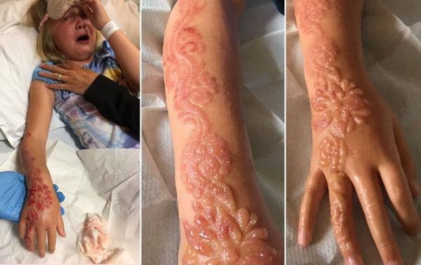 Una niña tatuada con henna marcada de por vida por las quemaduras que le produjo el químico