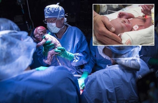 Nació el primer bebé de un trasplante de útero realizado en Estados Unidos