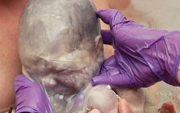 Parto velado: 15 imágenes sorprendentes de bebés que nacieron dentro de la bolsa
