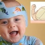 Plagiocefalia: cuando el bebé tiene la cabeza plana o deformada