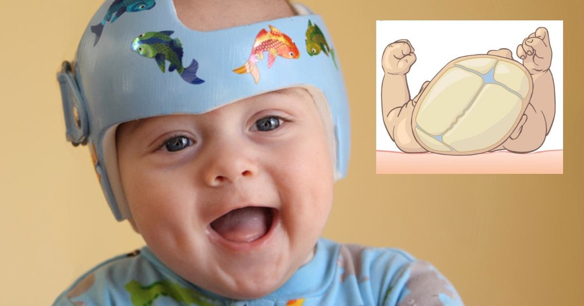 Casco Cabeza Plana De Un Lado Bebe Cabecita Plana En Bebes