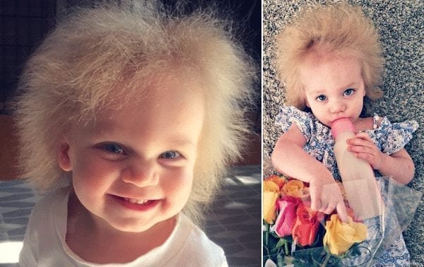 ¿Qué es el síndrome del cabello impeinable? Esta bebé lo tiene y la mamá nos cuenta su historia