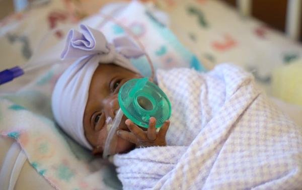 Nació el bebé más prematuro del mundo con un peso igual al de una manzana