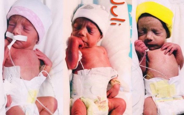 Nacieron trigemelas idénticas en Argentina a las 32 semanas de embarazo